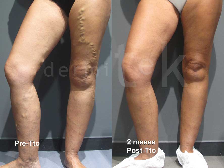 Por fin podras eliminar las horribles varices