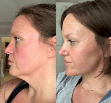 Cinta LIFTING FACIAL (Resultado Inmediato)